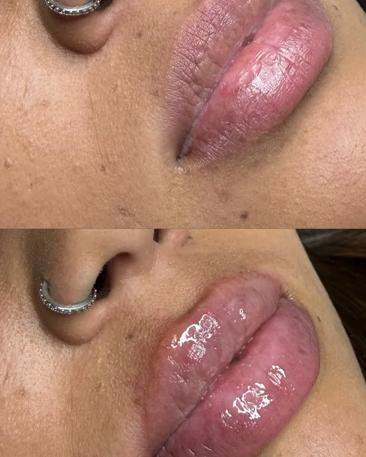 Antes e depois dos lábios com hidragloss