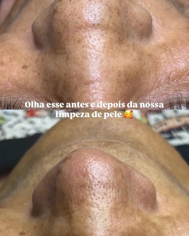Antes e depois de limpeza de pele no nariz
