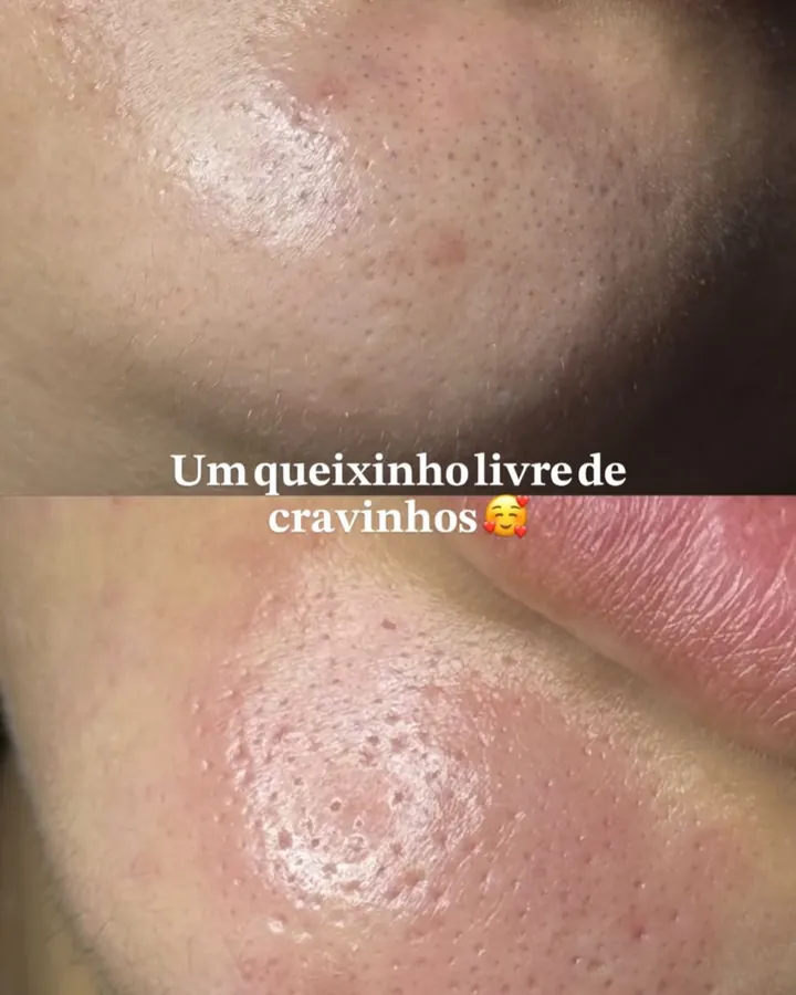 Antes e depois do queixo sem cravos após a limpeza de pele